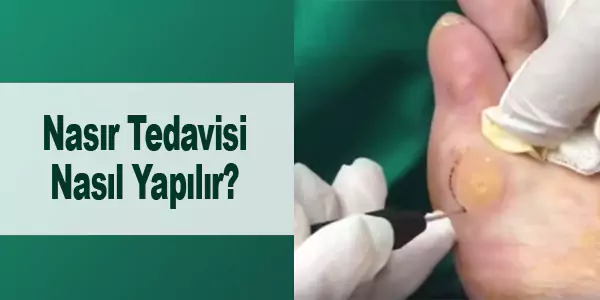 nasır tedavisi nasıl yapılır