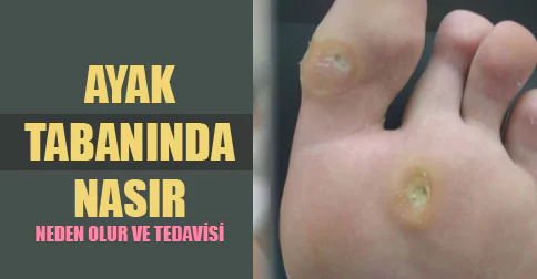 ayak tabanında nasır