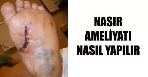 nasır ameliyatı nasıl yapılır