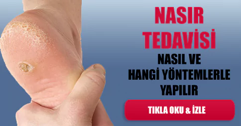 nasır tedavisi