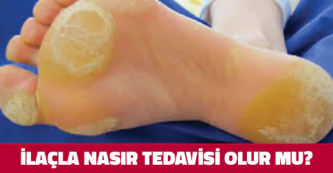 ilaçla nasır tedavisi