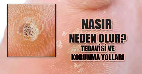 nasır neden olur