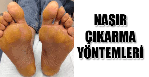 nasır çıkarma yöntemleri